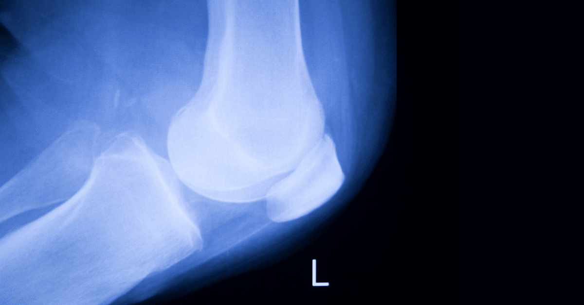 Knee Injury Claim Guide Coleman Legal LLP