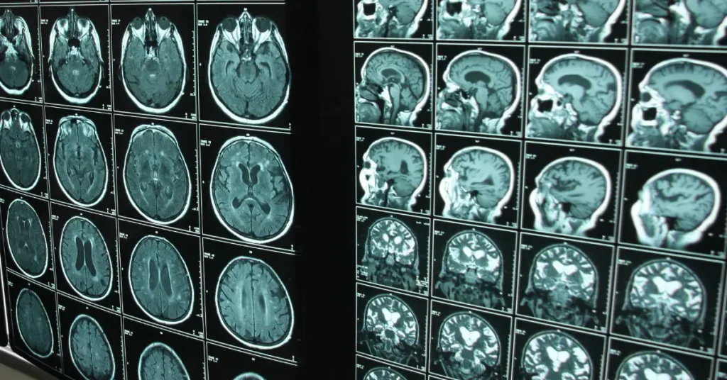 Sodium Valproate Inquiry [2025] Coleman Legal LLP